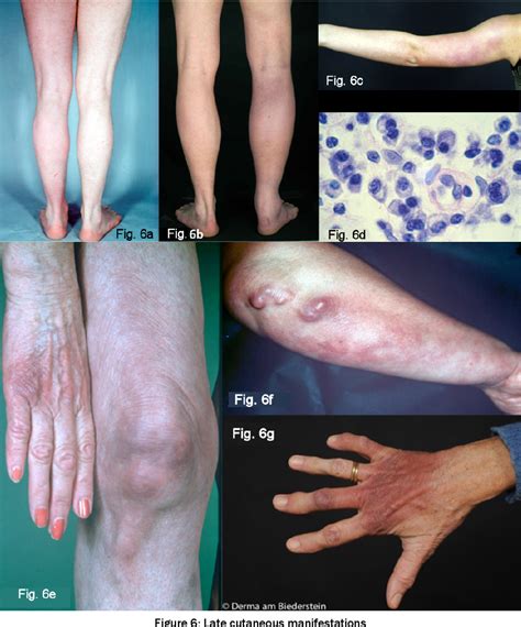 Figure 6 From Cutaneous Lyme Borreliosis Guideline Of The German