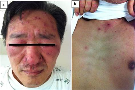 Clusters Of Erythematous Papules And Crusts Are Seen On The Patients
