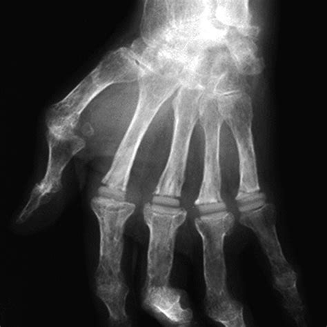 Pa Radiograph Of Kienbock Disease Current Treatment Recommendations Are
