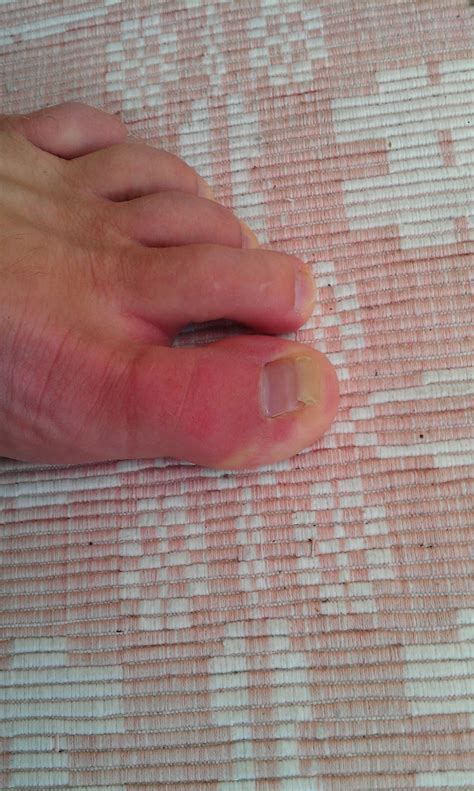Erythromelalgia In Toes Info Not Crps Complex Regional Pain Syndrome