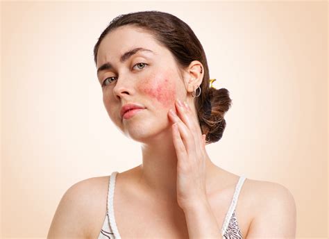 The Psychodermatologist What Is Rosacea