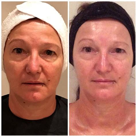 Thermage Before And After Photos Face 5 Thermage Facelift Face