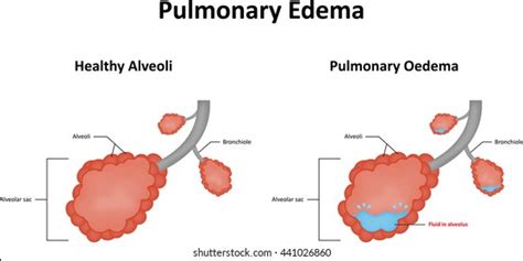 Alveoli Labelled Diagram 스톡 벡터로열티 프리 412621612 Shutterstock