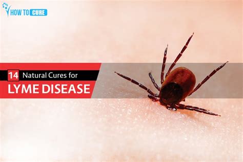 14 Natural Cures For Lyme Disease Lyme Disease Natural Treatment