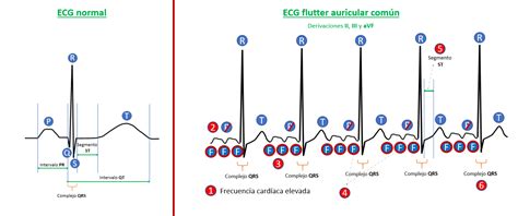 Ecg Flutter Auricular Explicación Sencilla De Los Criterios