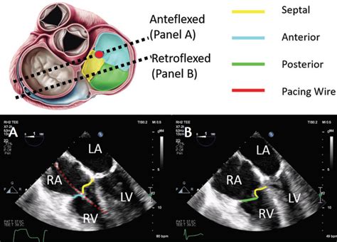 Imaging Considerations For Percutaneous Tricuspid Intervention