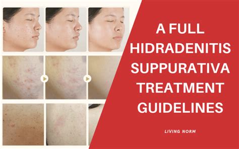 A Full Hidradenitis Suppurativa Treatment Guidelines Living Norm