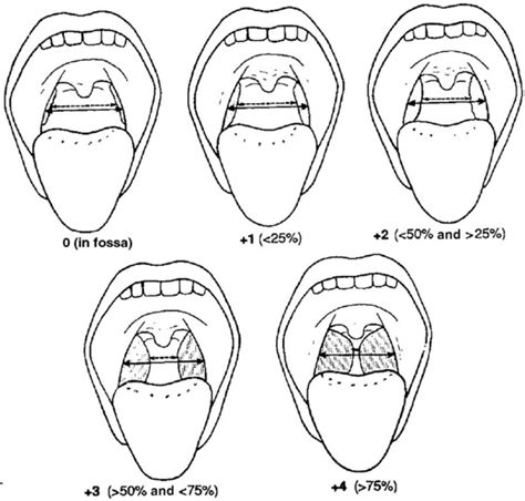 Pediatric Tonsil Cancer A National And Institutional Perspective The