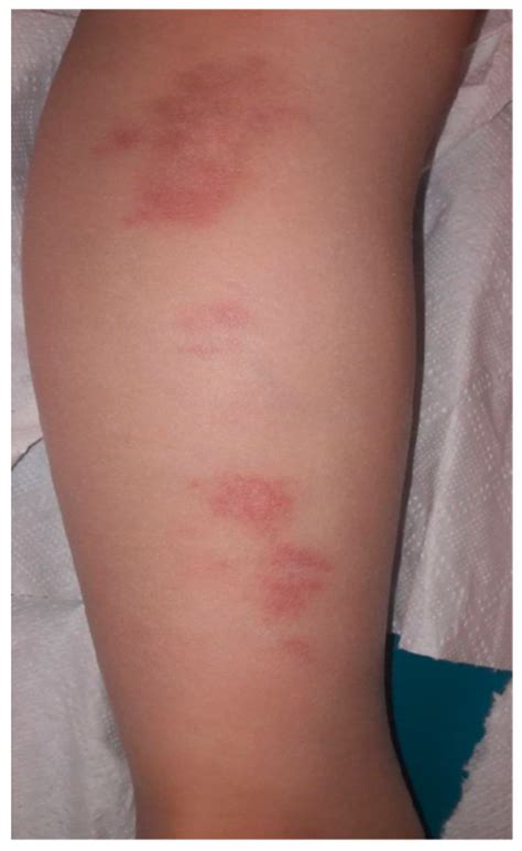 Life Free Full Text Cutaneous Manifestations Of Lyme Borreliosis In