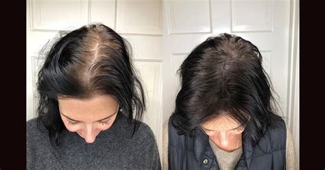 Scalp Micropigmentation Benefits Side Effects Before And After Pics