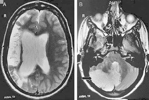 A Axial T2 Weighted Mri Of The Brain Showing Areas Of Old Infarct