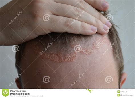 Psoriasis On The Skin Close Up Scalp Photos Of Dermatitis And Eczema