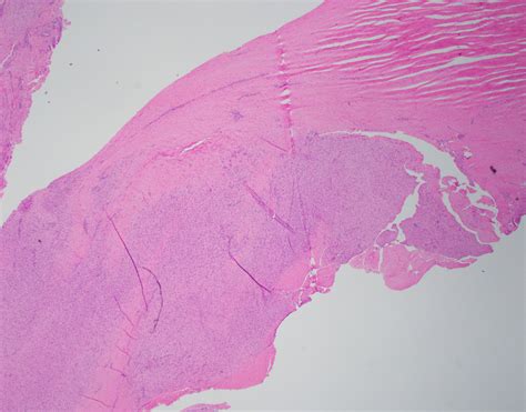 Pathology Outlines Fibromatosis Palmar Plantar