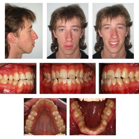 Fronto Lateral Intraoral Photographs During Treatment Showing Open Bite