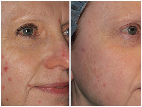 Bbl Acne Laser Treatment At Pynch Anti Aging And Med Spa Services