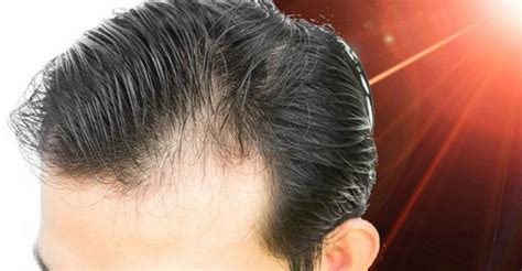 lllt  level laser light therapy  hair loss lllt
