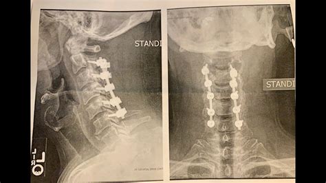 2 Month Post Surgery Posterior Cervical Decompression And Fusion C2 C6