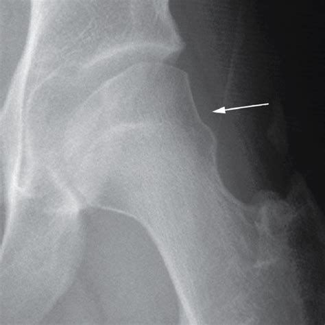 A Anteroposterior Plain Radiograph Of The Left Hip Demonstrating A