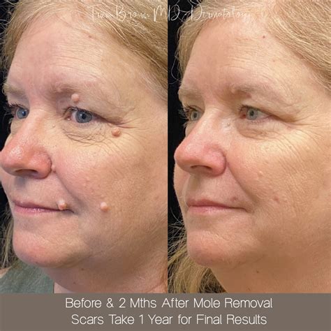 Moles Cosmetic Removal Houston Tx Dermatologist