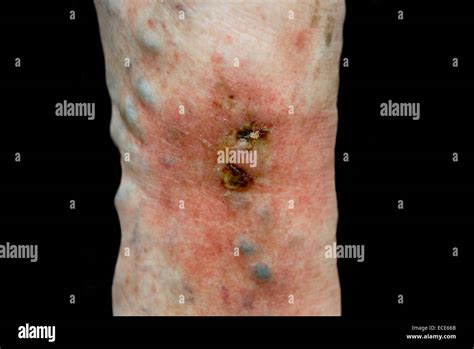 Varicose Ulcer Situated On Varicose Hi Res Stock Photography And Images