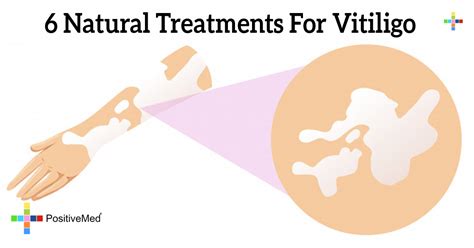 6 Natural Treatments For Vitiligo