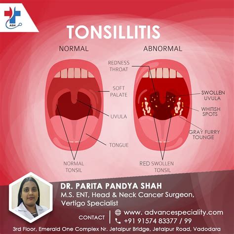 Signs And Symptoms Of Tonsillitis Tonsillitis Is Inflammat Flickr