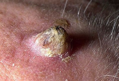 Youtube a cutaneous horn growing out of a forehead. Cutaneous Horns Picture Image on MedicineNet.com