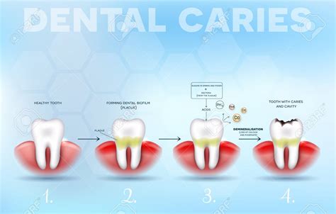 Symptoms And Treatments Of Dental Caries Check Biotech First