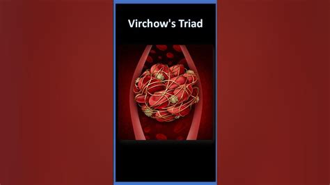 Virchows Triad Of Thrombosis Shorts Medicaltriads Youtube