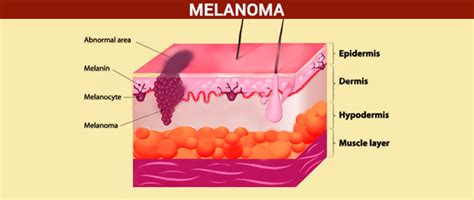 Skin Cancer Types And Causes Symptoms Treatment And Risk Factors Byjus
