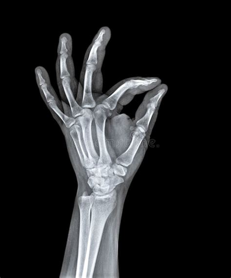 X Ray Of Human Hand Stock Image Image Of Rays Radiation 95030599