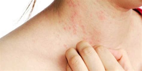 Dermatitis Causas Tipos Y Tratamiento Afecci Nes De Piel