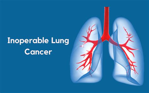 Ikris Pharma Blog Inoperable Lung Cancer