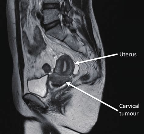 Magnetic Resonance Imaging Of The Pelvis T2 Weighted Sagittal View