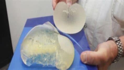 breast implants welsh nhs to replace privately fitted pip implants bbc news