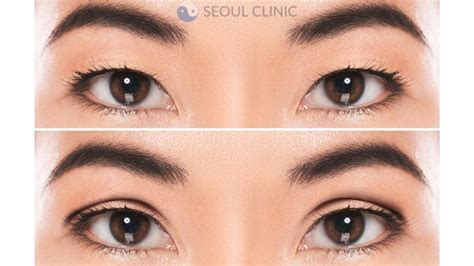 Double Eyelid Surgery Korea In 2024 Costs Clinics And More