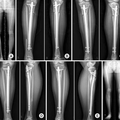 Pdf Corrective Tibial Osteotomy In Young Adults Using An