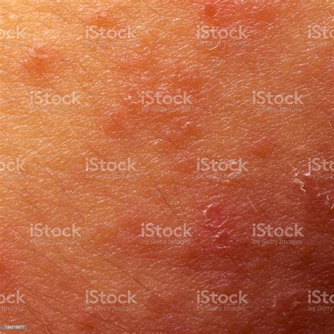 Eczema Atopic Dermatitis Symptom Skin Texture Stock Photo Download