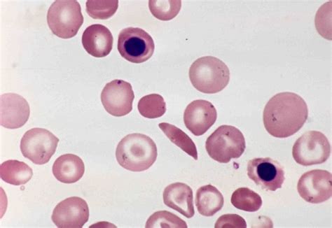 Overall Rbc Morphology And Blood Smear Findings In Anemias Rbc