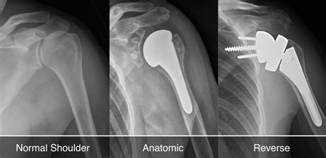 Reverse Shoulder Replacement What You Need To Know Shoulder And Elbow