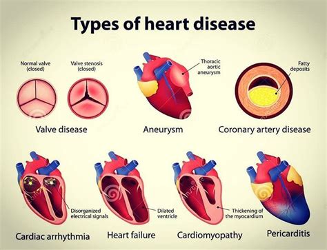 List And Explain Four Different Types Of Cardiovascular Diseases