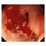 Endoscopic Appearance Of Post ESD Ulcer With Active Bleeding 