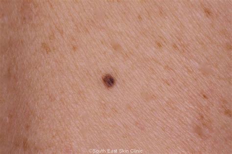 Atypical Mole South East Skin Clinic