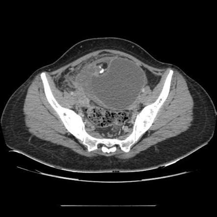 Mature Cystic Teratoma Radiology Case Radiopaedia Org