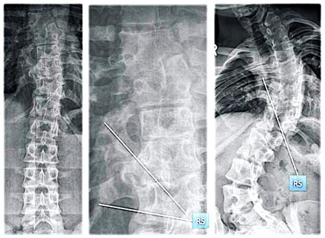 9 Two Patients With Congenital Scoliosis And Rib Synostosis Rs