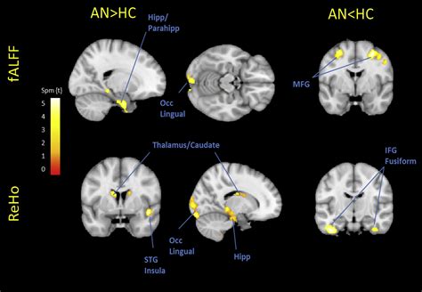 Abnormal Spontaneous Regional Brain Activity In Young Patients With