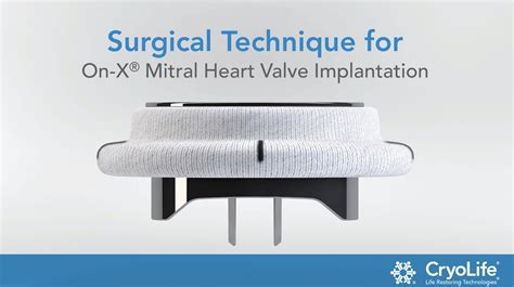 Surgical Technique For On X® Mitral Heart Valve Implantation Cryolife