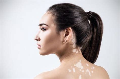 Mengenal Si Kulit Belang Vitiligo Penyebab Dan Cara Mengatasi Grid