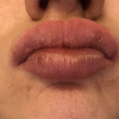 Small White Spots On Lips After Filler Lips Makeupview