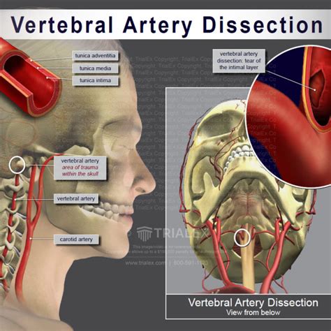 Vertebral Artery Dissection Trialexhibits Inc